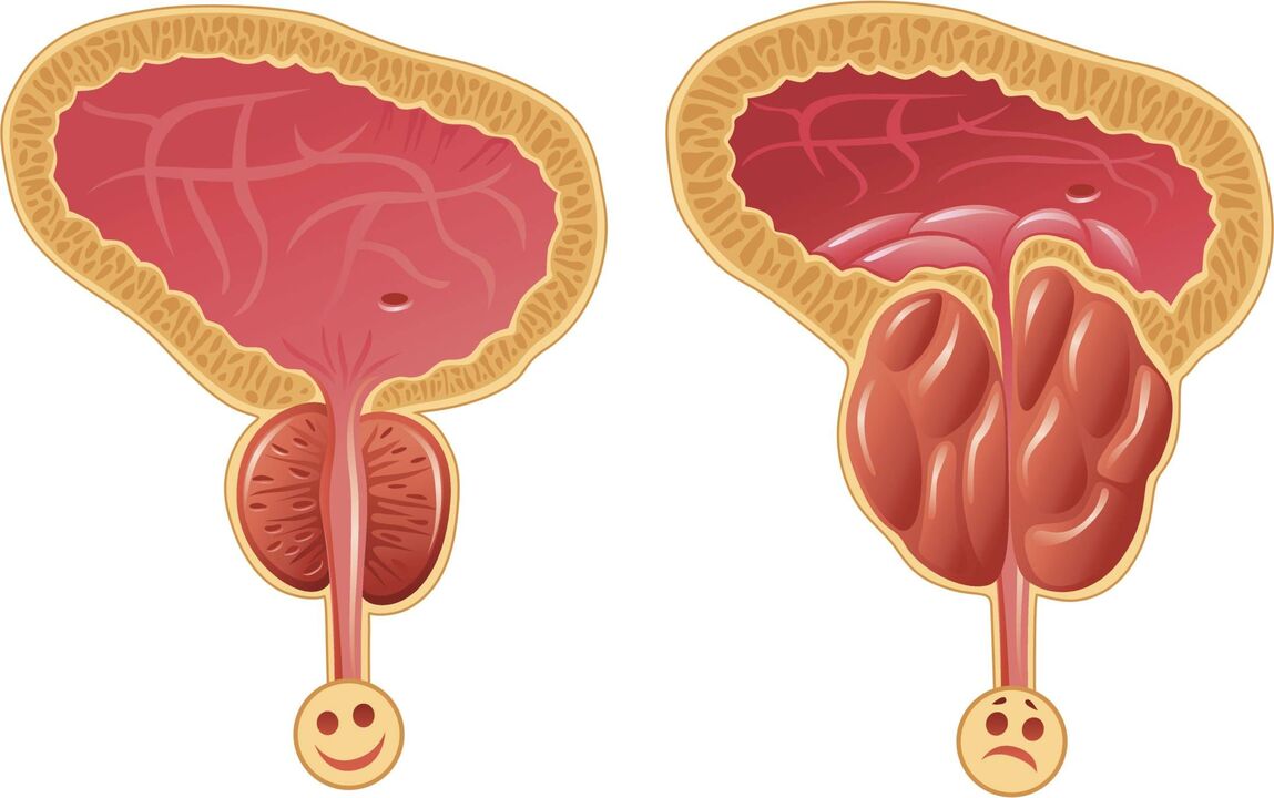 Gründe für die Entwicklung einer Prostatitis