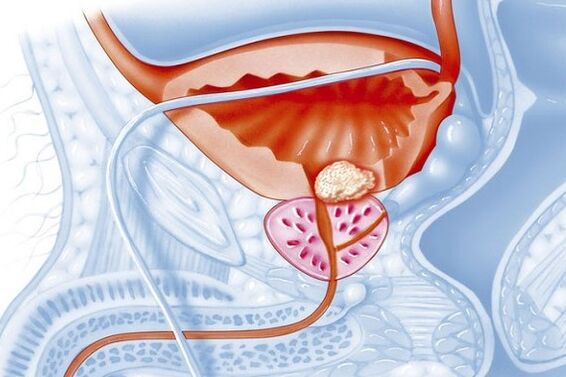 Entzündlicher Prozess in der Prostata