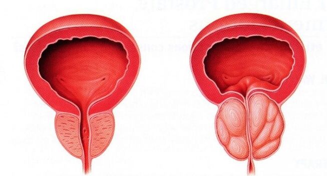 Gesunde und entzündete Prostata mit chronischer Prostatitis.