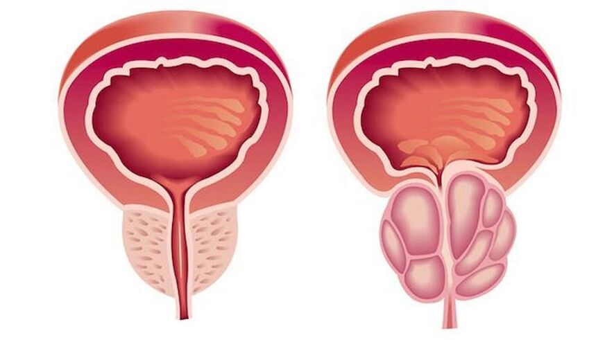 Gesunde und entzündete Prostata mit Prostatitis