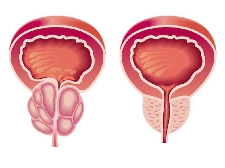 Wie Prostatitis aussieht